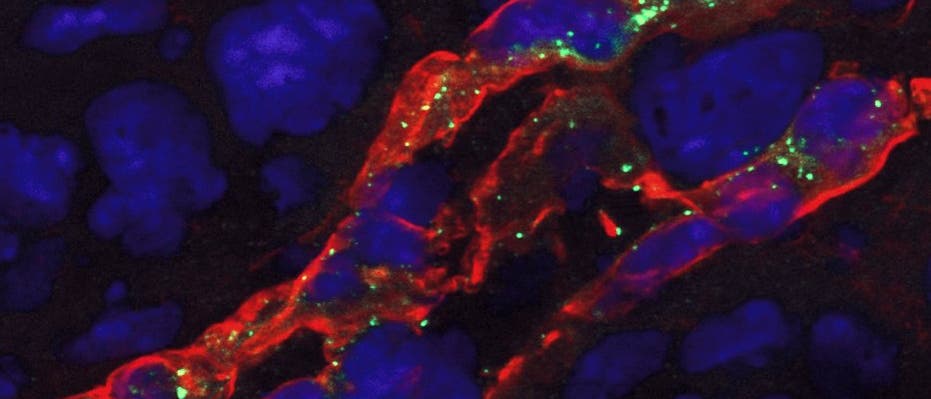 Angiogenese bei Tumorgefäßen Angiogenese bei Tumorgefäßen