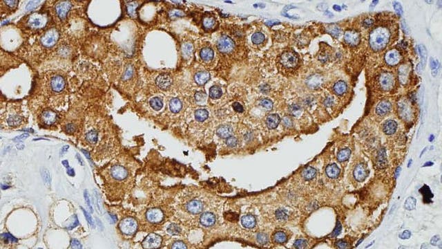 Virusproteine in Prostatazellen