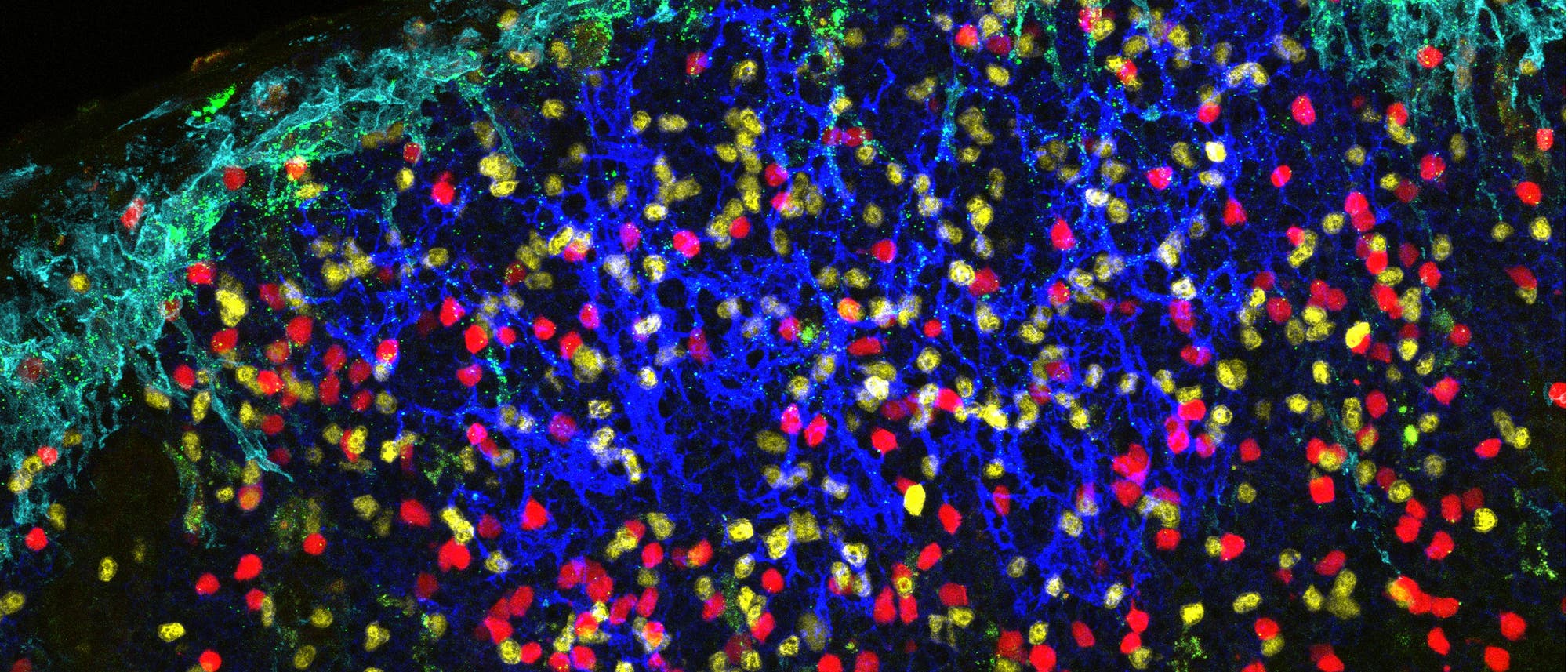 Bunte Angriffswelle von HIV in Lymphknoten Bunte Angriffswelle von HIV in Lymphknoten