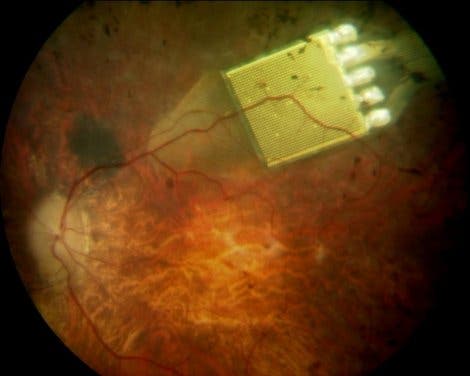 Retina.-Implantat