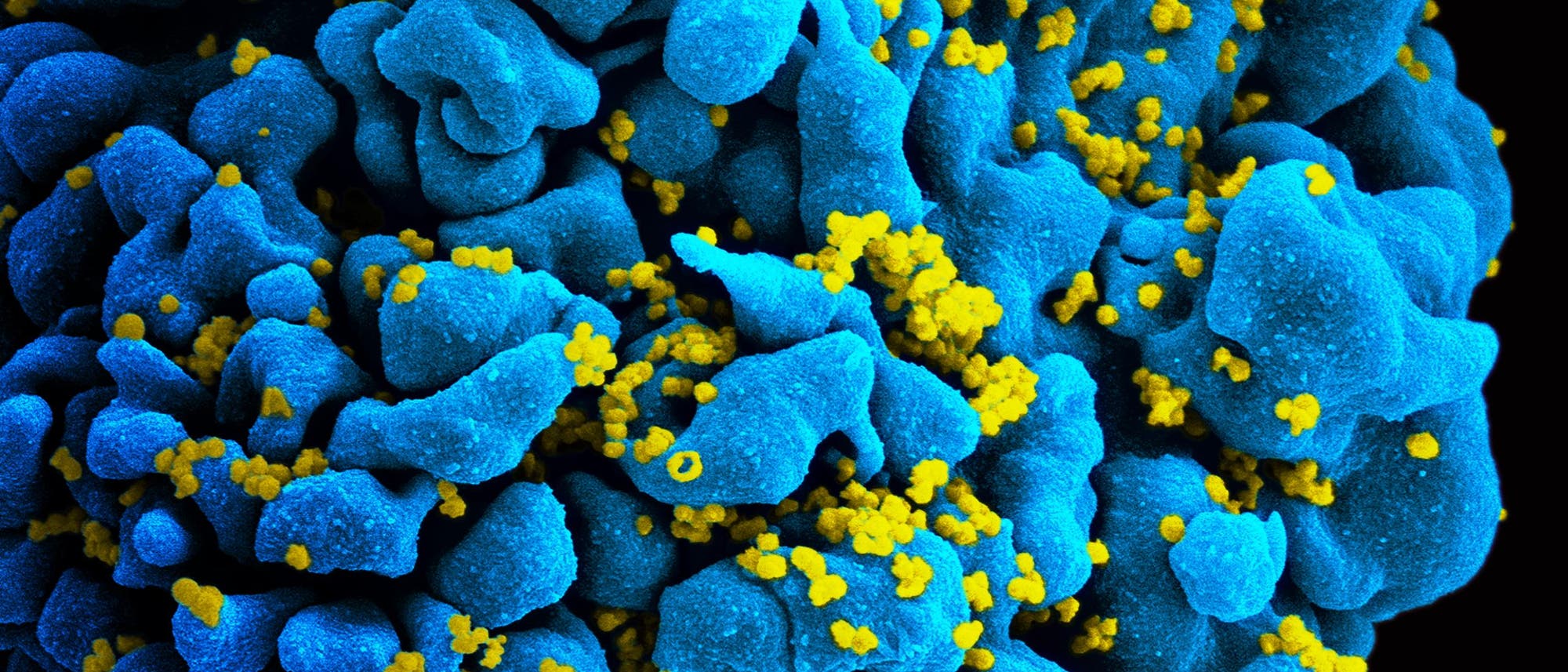Mit HIV-1 infizierte T-Zelle Mit HIV-1 infizierte T-Zelle