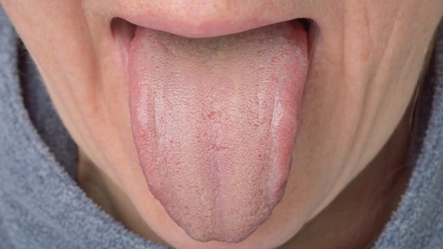 herausgetreckte belegte Zunge