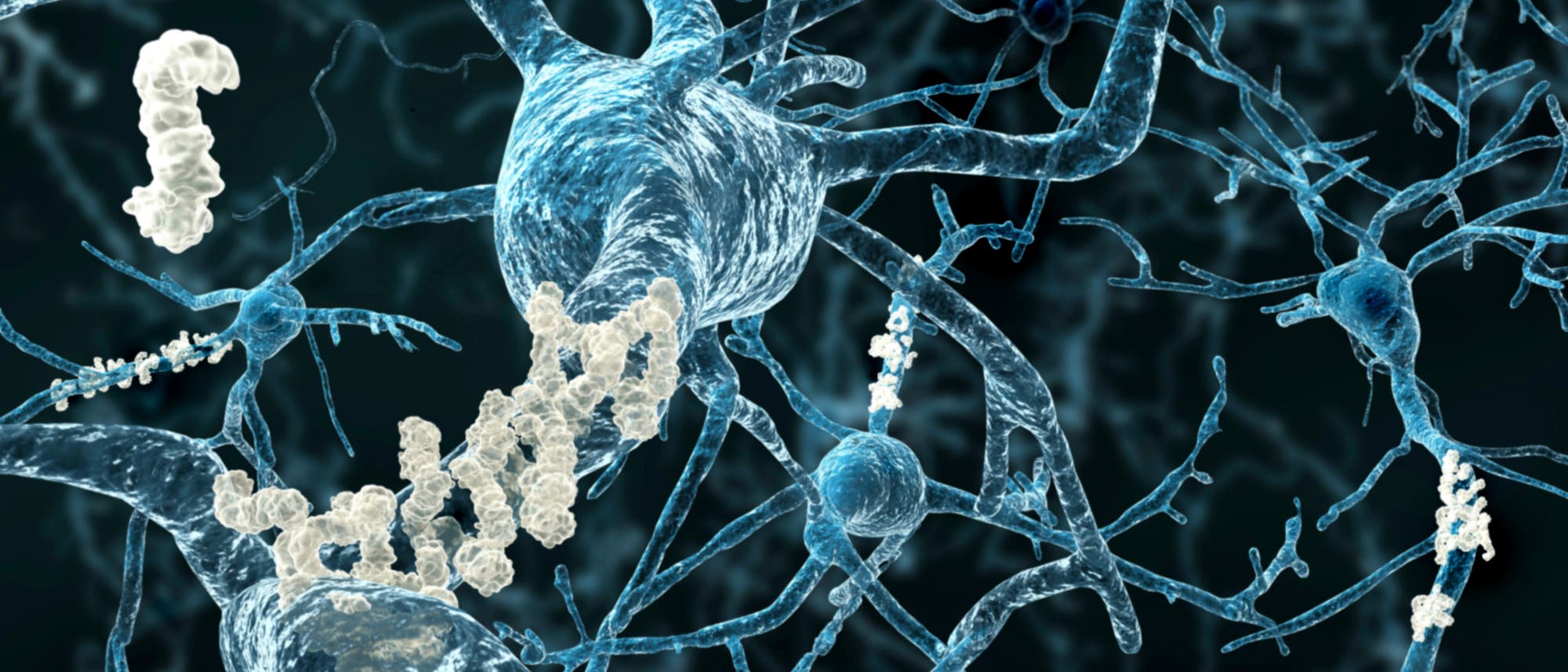 Alzheimer: Plaques zwischen Neuronen Alzheimer: Plaques zwischen Neuronen