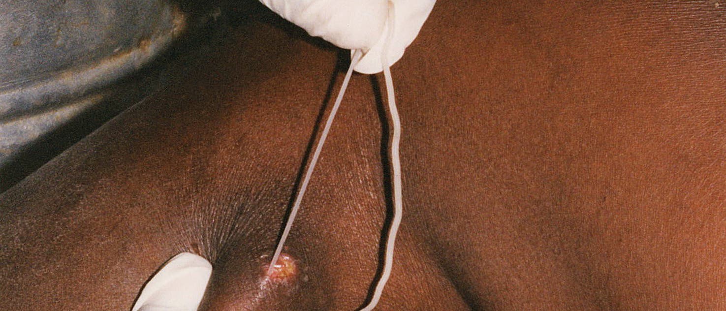 5 Dracontiasis: die Guineawurm-Krankheit 5 Dracontiasis: die Guineawurm-Krankheit