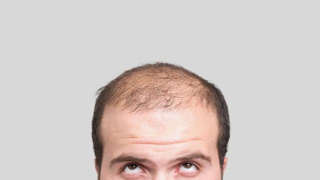 Mann mit Haarausfall 