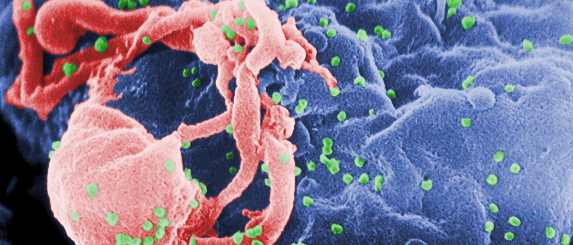 HI-Viren (grün koloriert), die von einem Lymphozyten freigesetzt werden. HI-Viren (grün koloriert), die von einem Lymphozyten freigesetzt werden.