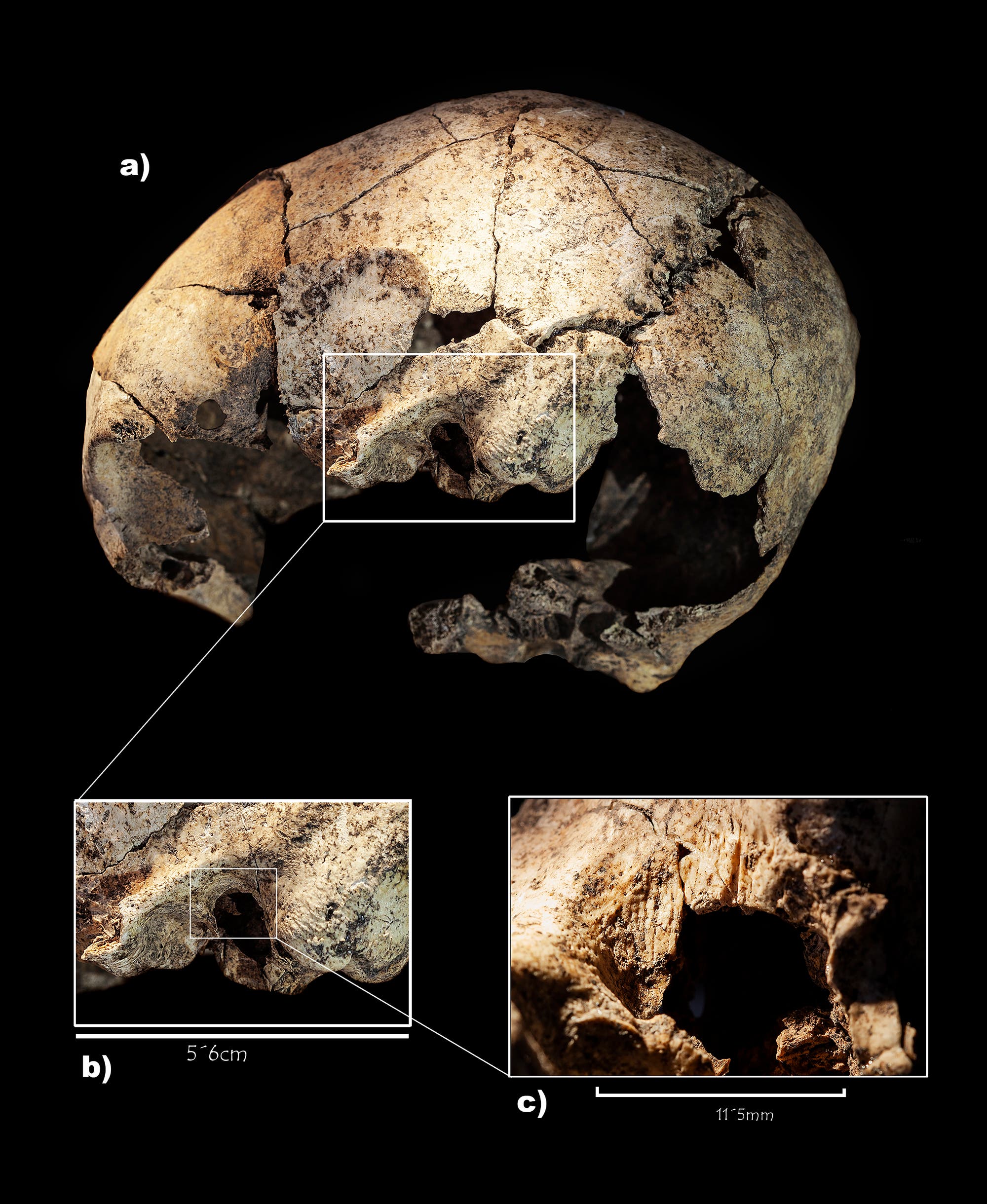 Cirugía exitosa en el cráneo hace 5300 años