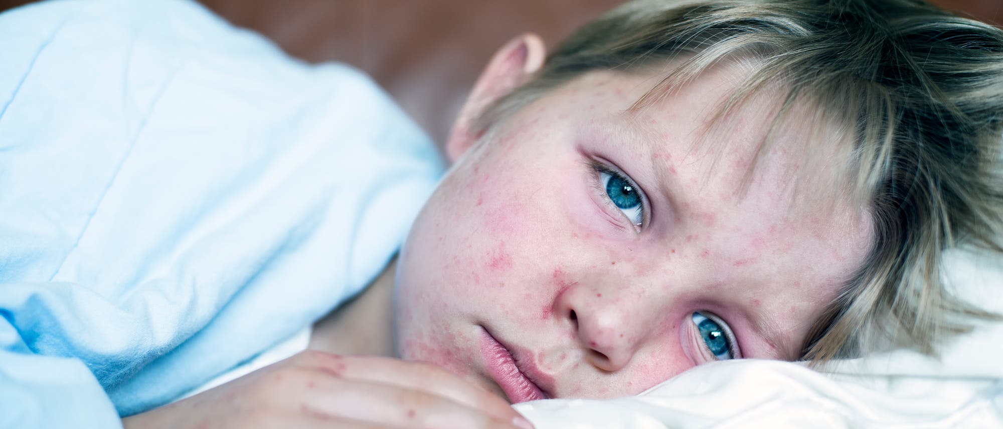 Junge liegt mit Masern im Bett und guckt betrübt Junge liegt mit Masern im Bett und guckt betrübt