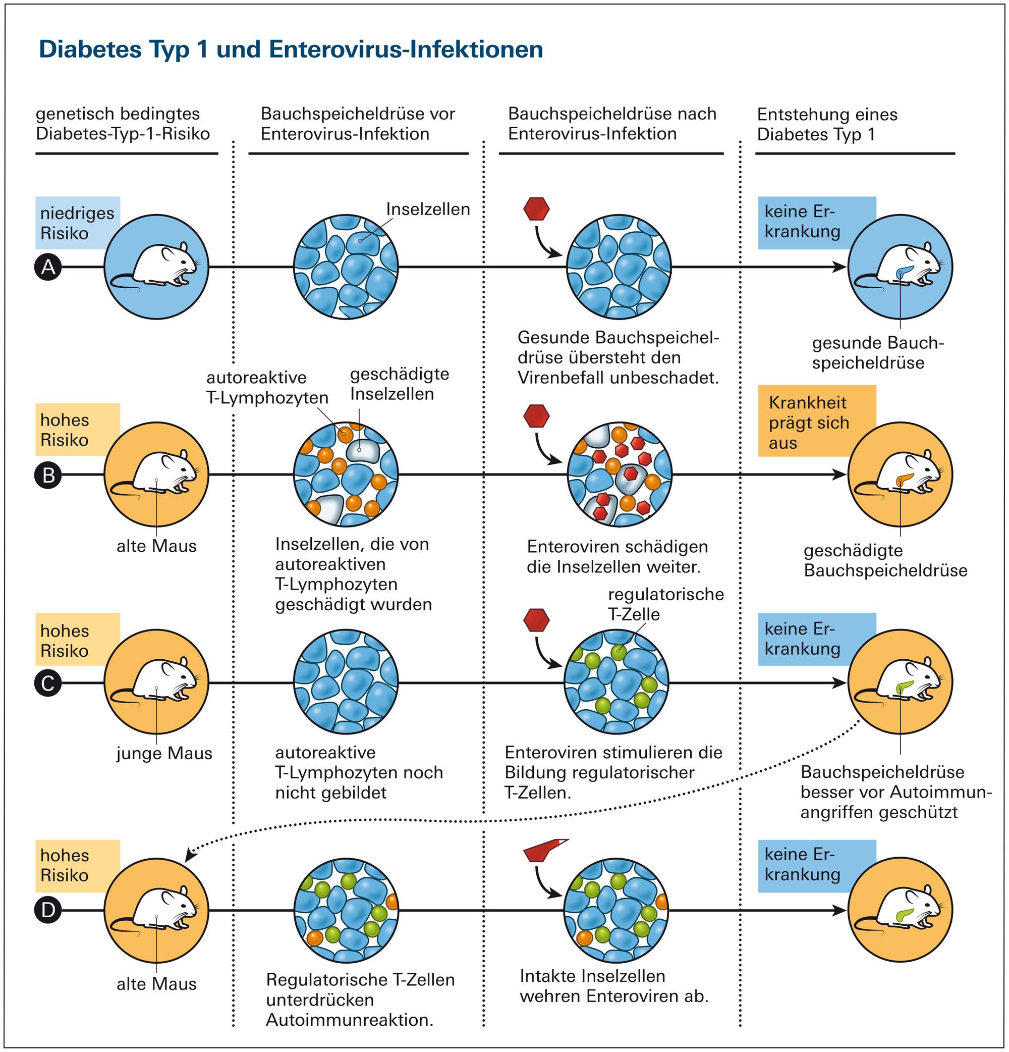 Diabetes Typ 1 und Enterovirus-Infektionen