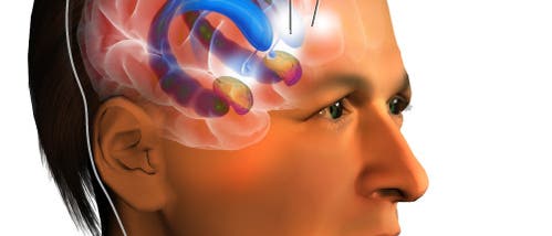 Zeichnung einer Tiefenhirnstimulation im Nucleus accumbens Zeichnung einer Tiefenhirnstimulation im Nucleus accumbens
