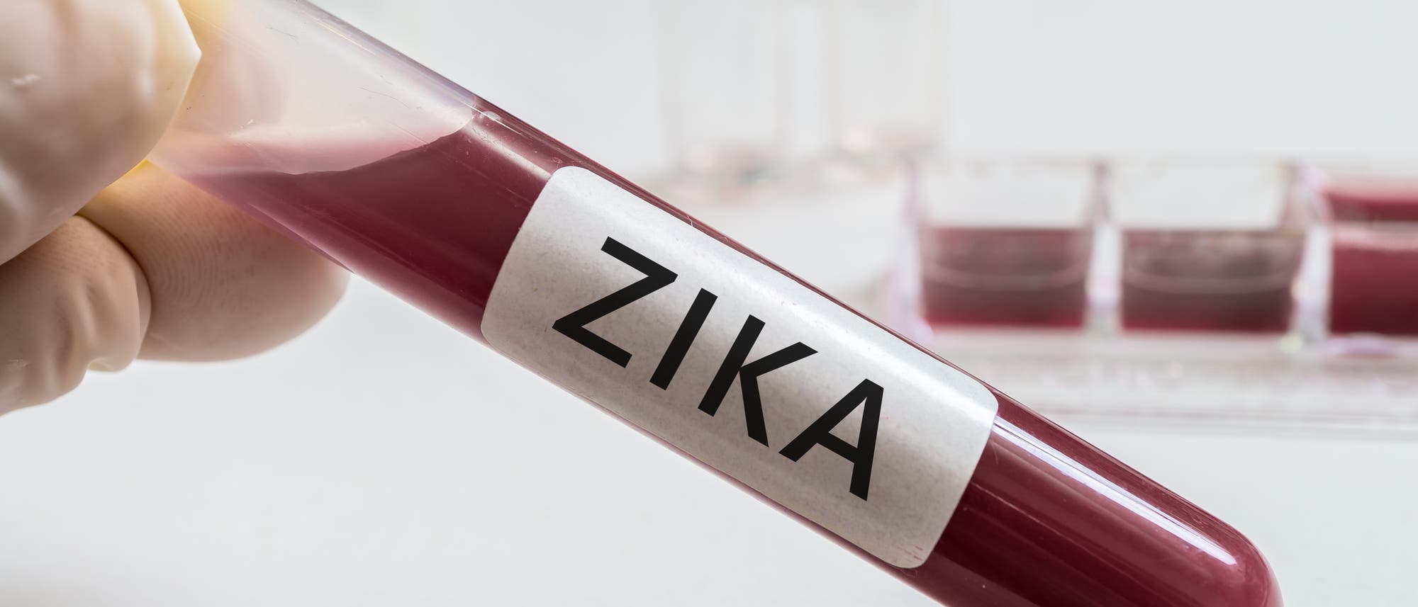 Zika-Nachweis im Blut Zika-Nachweis im Blut