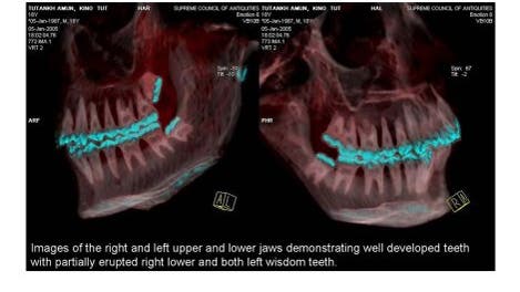 Die Zähne in der CT-Aufnahme