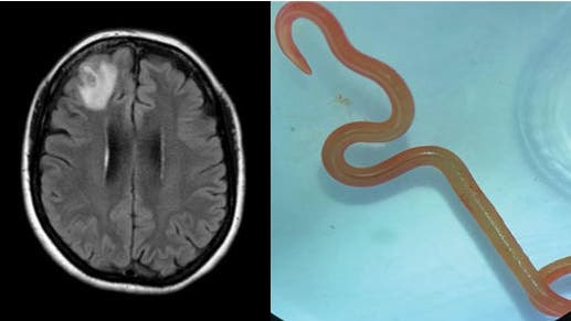 Hoe kwam een ​​levende worm de hersenen van een Australische vrouw binnen?