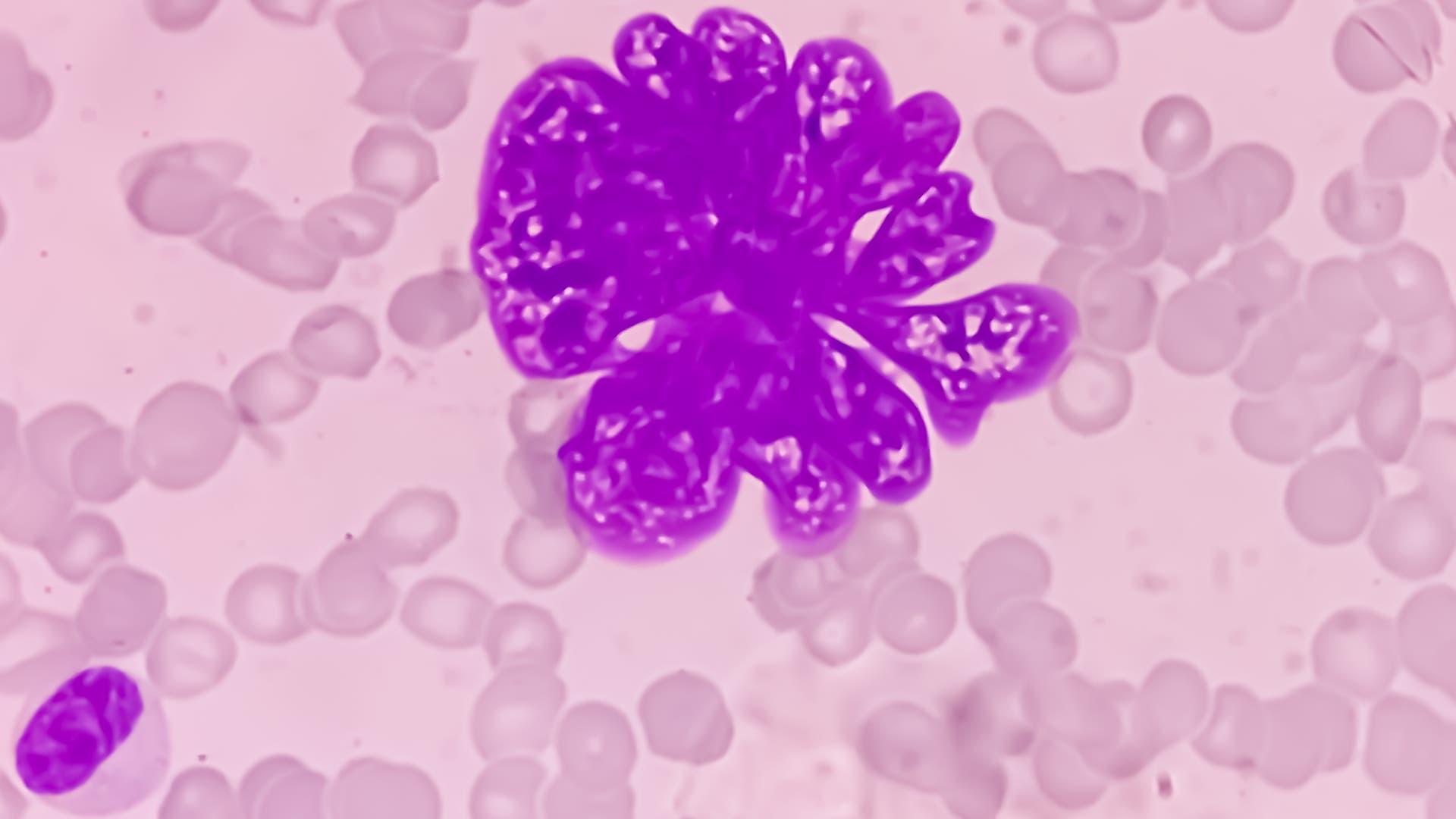 Metastasen-So-breitet-sich-Krebs-im-K-rper-aus