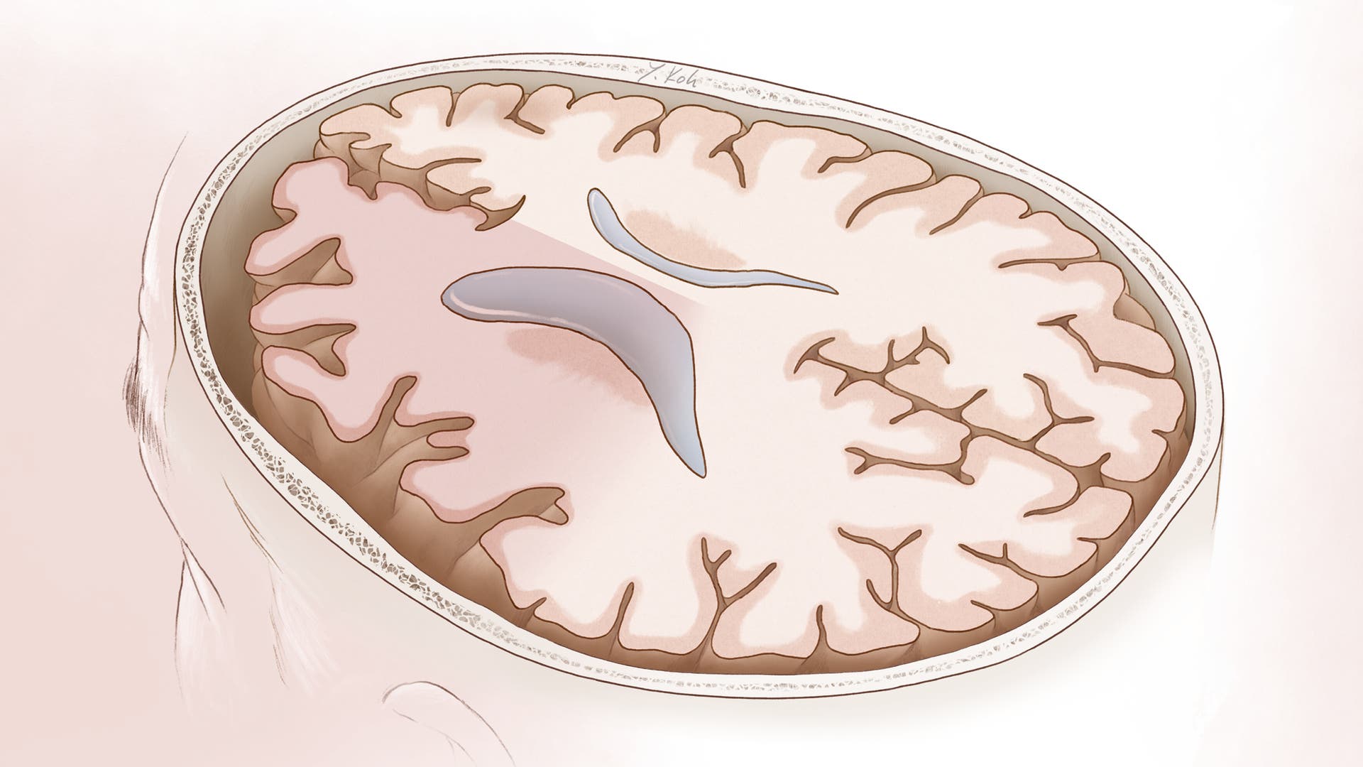 Infografik-Wie-sich-das-Gehirn-im-Alter-ver-ndert