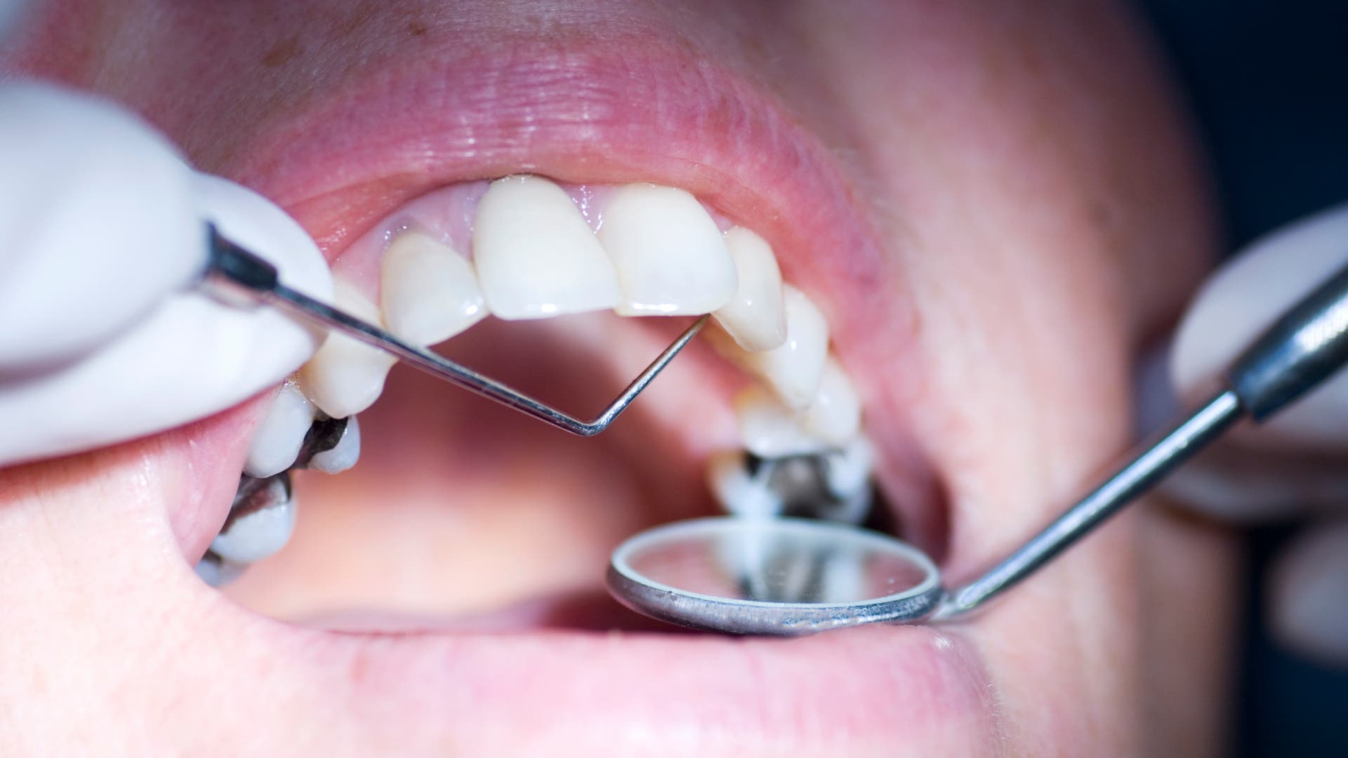 Mercury: The European Union agrees to ban amalgam dental fillings