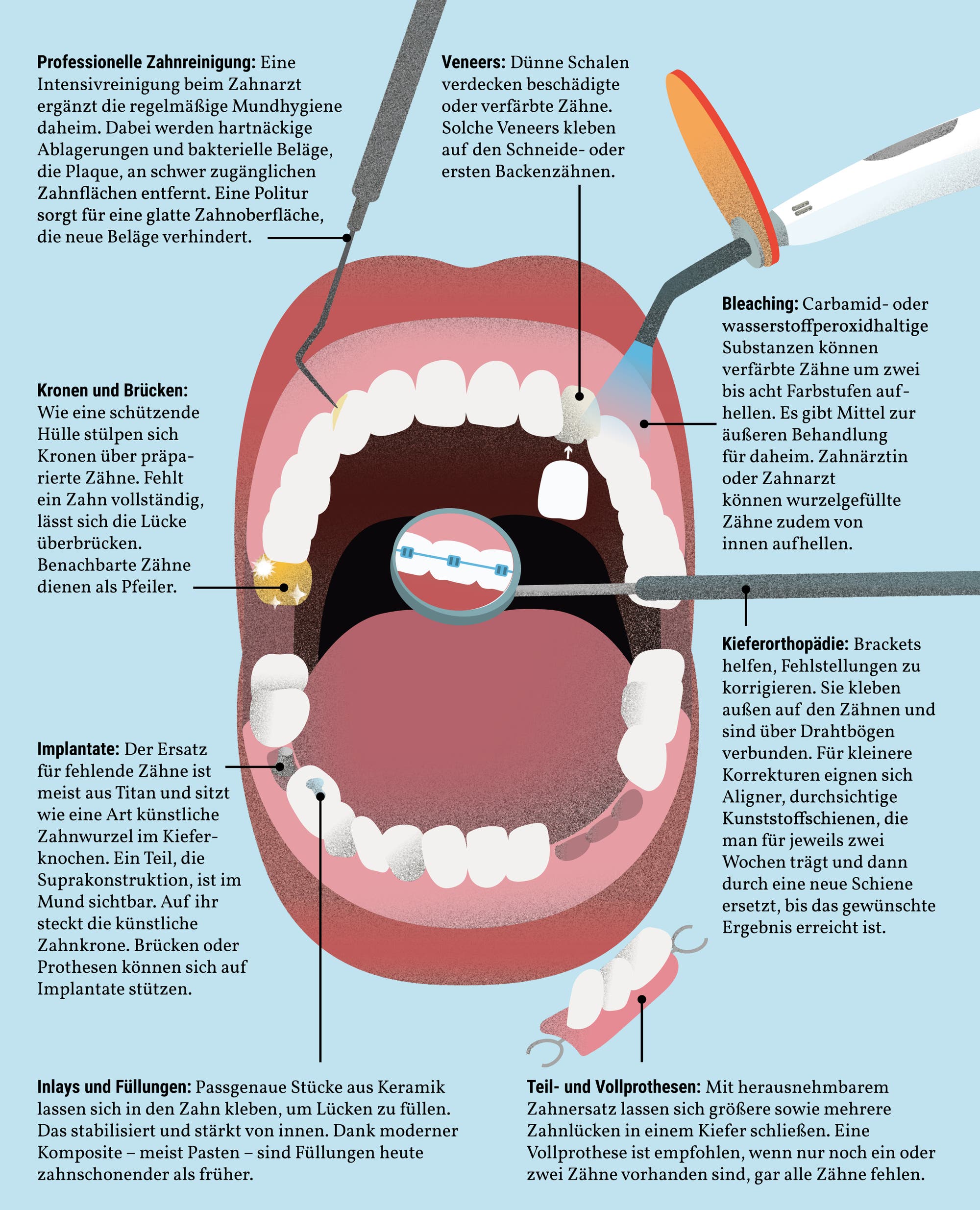 Professionelle Zahnreinigung und Veneers sind zwei Möglichkeiten, um Zähne zu reparieren und verschönern, wie die Grafik zeigt.