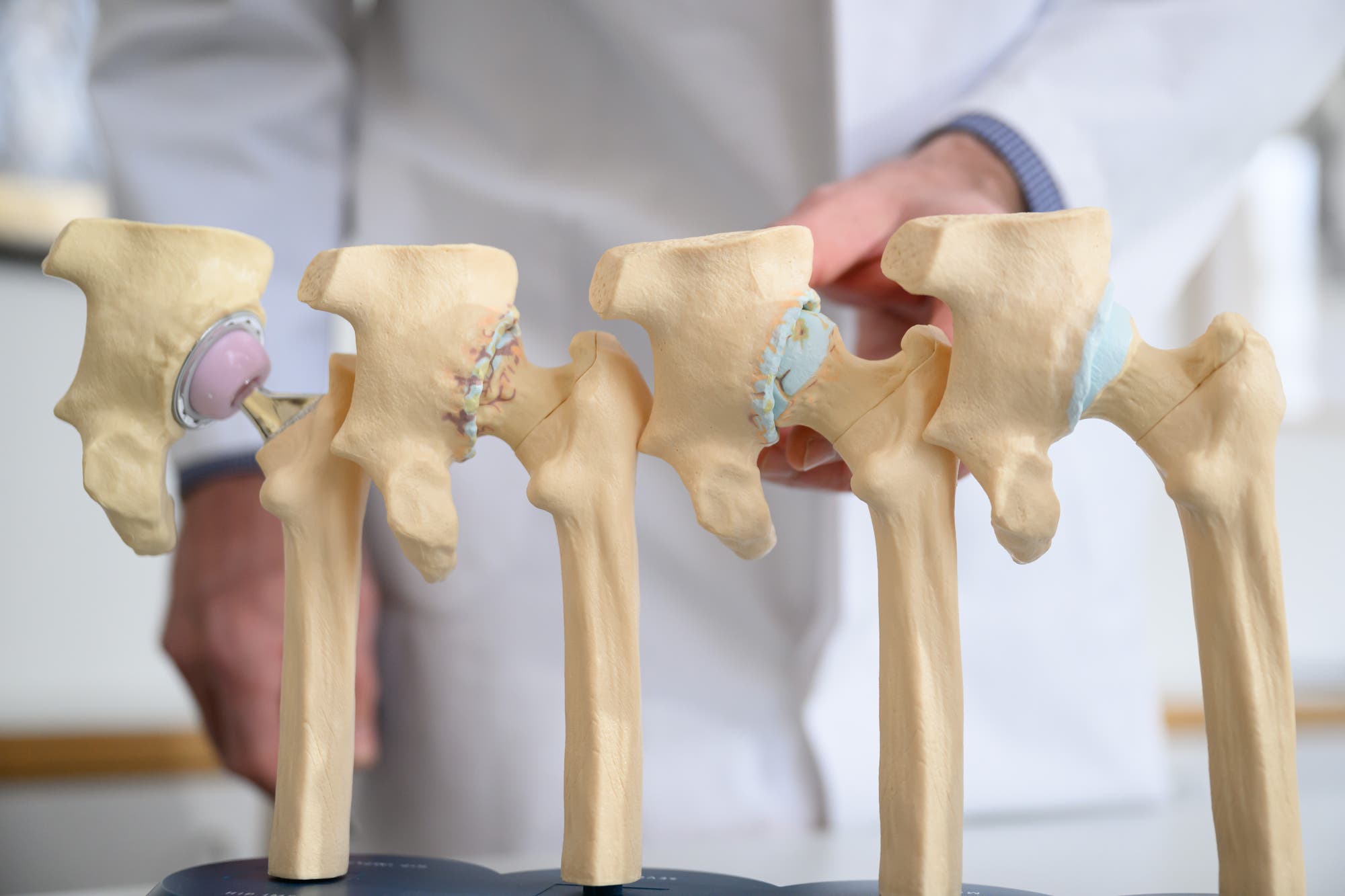 Ein anatomisches Modell zeigt vier menschliche Hüftgelenke in verschiedenen Stadien der Degeneration. Von links nach rechts: ein gesundes Gelenk mit einer künstlichen Hüftprothese, ein leicht degeneriertes Gelenk, ein stärker degeneriertes Gelenk und ein stark abgenutztes Gelenk. Im Hintergrund ist eine Person in einem weißen Kittel zu sehen, die das Modell präsentiert. Das Bild veranschaulicht den Fortschritt von Gelenkverschleiß und die Anwendung von Prothesen.