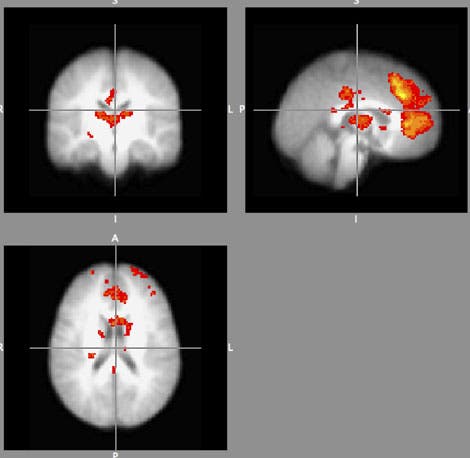 Altruistische Gehirnaktivität in Nucleus accumbens und Insula