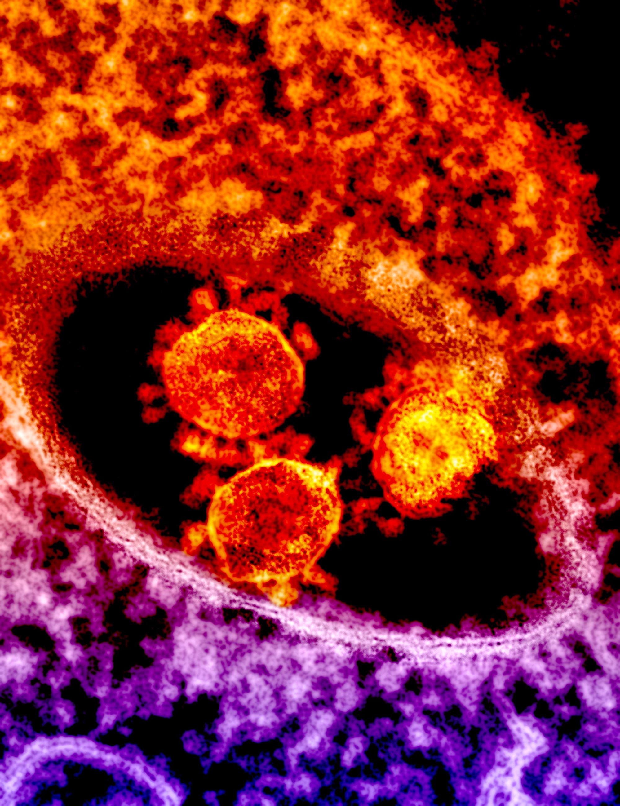 Coronavirus unter dem Elektronenmikroskop