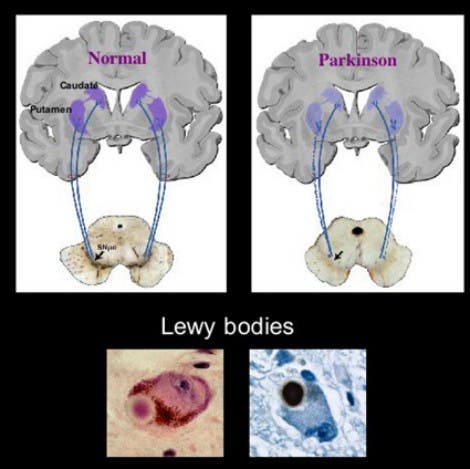 Lewy-Körperchen kennzeichnen die Parkinson-Erkrankung