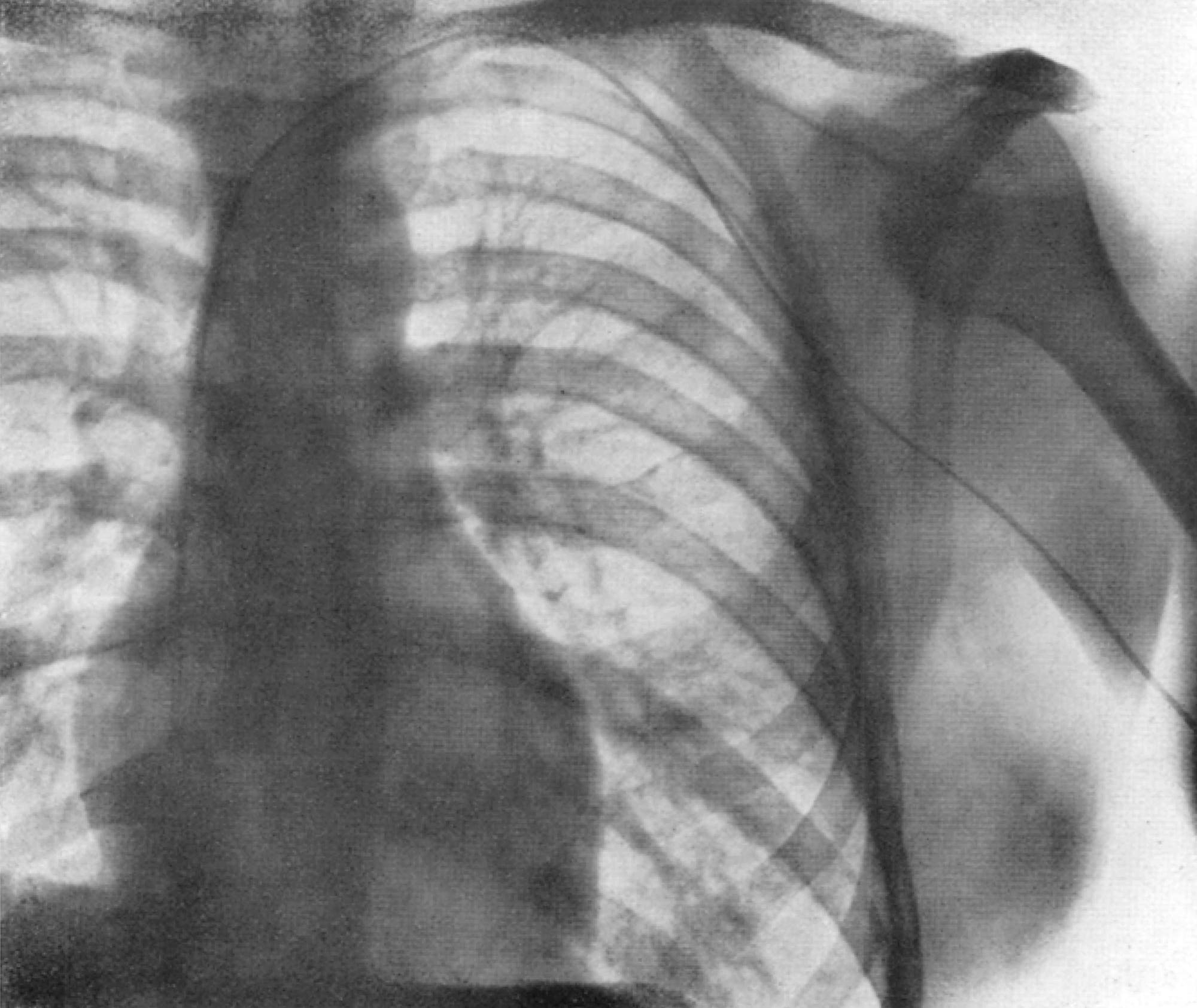 Röntgenaufnahme des eingeführten Katheters im Herzen von Werner Forßmann