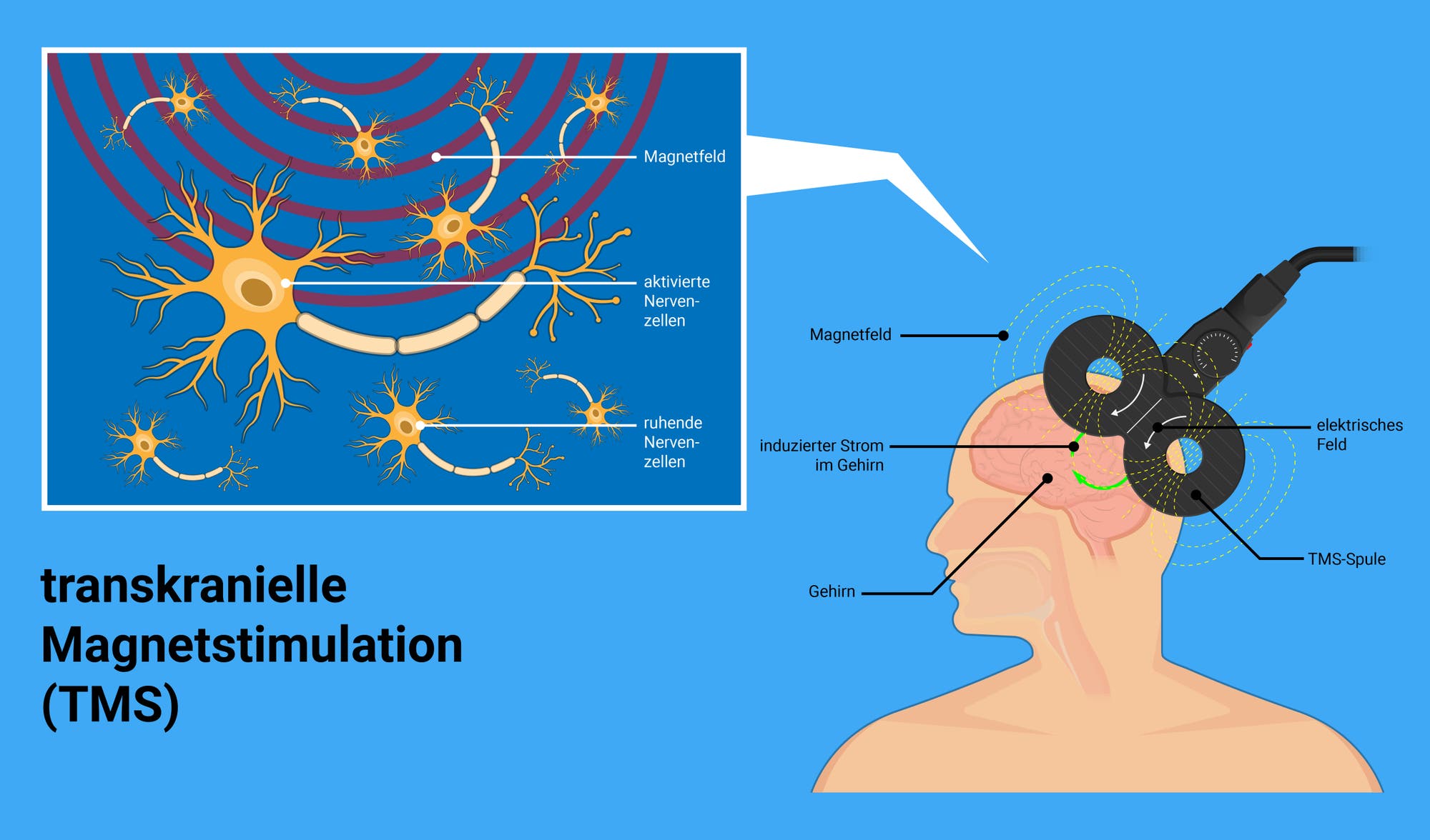 Infografik: Wie wirkt eine transkranielle Magnetstimulation im Gehirn