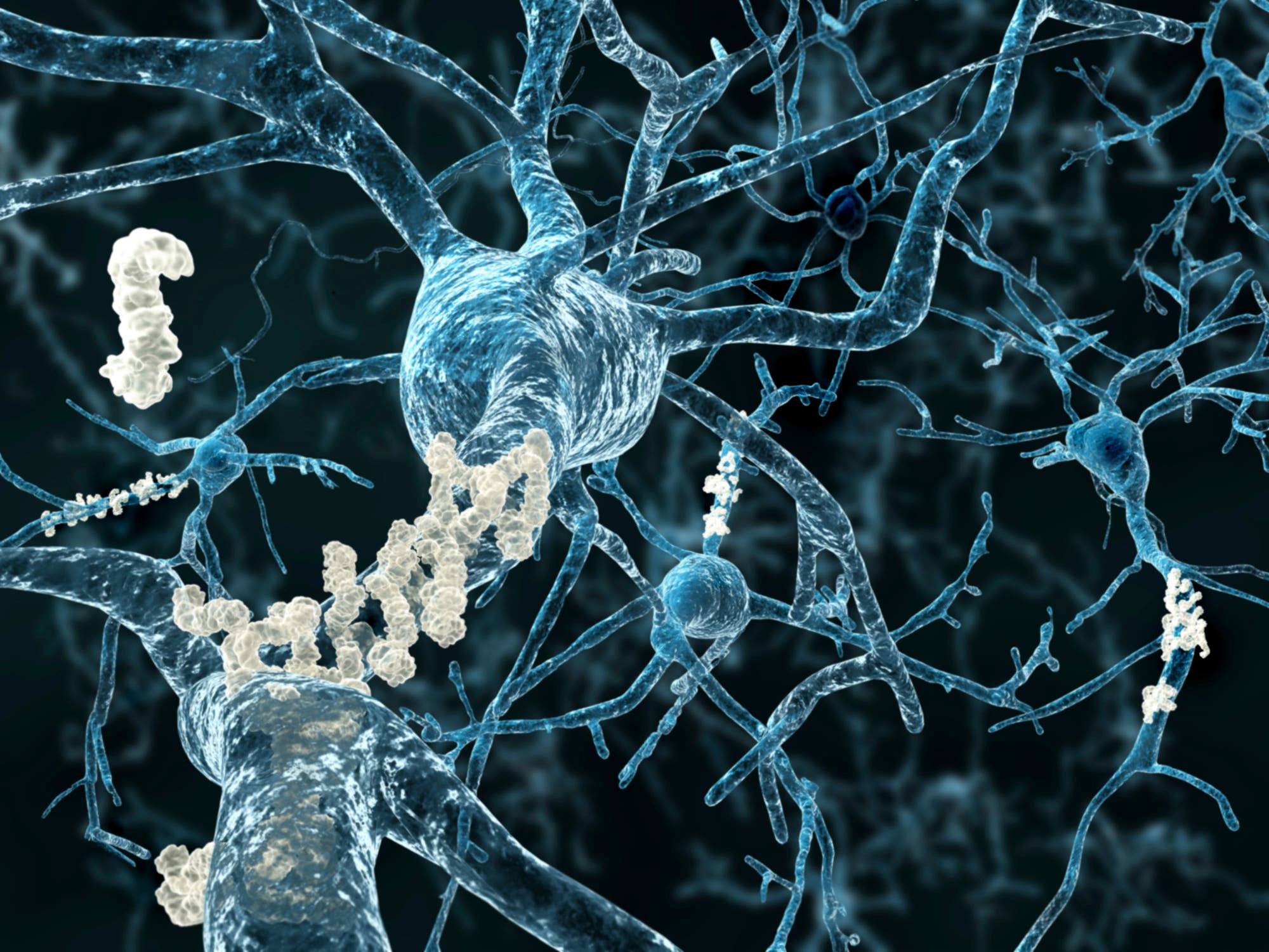 Alzheimer: Plaques zwischen Neuronen