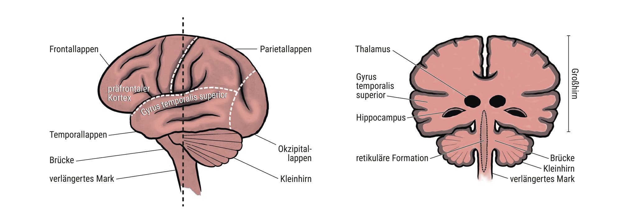 Das Bild zeigt zwei anatomische Diagramme des menschlichen Gehirns. Links ist eine seitliche Ansicht mit Beschriftungen der Hirnlappen: Frontal-, Parietal-, Temporal- und Okzipitallappen. Weitere markierte Bereiche sind der präfrontale Kortex, der obere temporale Gyrus, Pons, Medulla und das Kleinhirn. Rechts ist eine frontale Schnittansicht mit dem Thalamus, dem oberen temporalen Gyrus, dem Hippocampus, der Formatio reticularis, Pons, Medulla und dem Kleinhirn. Beide Diagramme heben die Struktur und Lage der Hirnregionen hervor.
