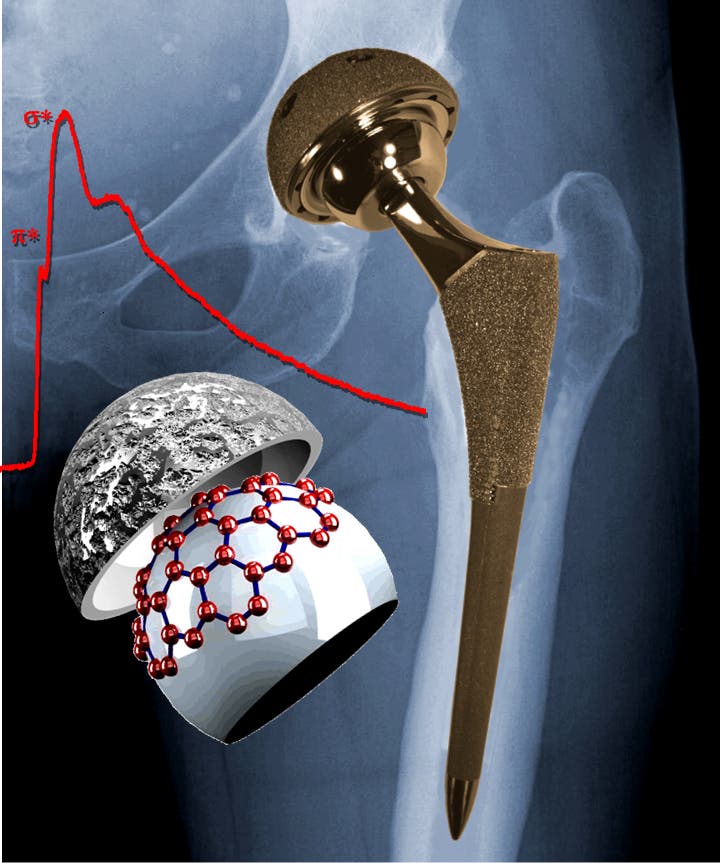 Röntgenaufnahme eines Hüftimplantats aus Metall