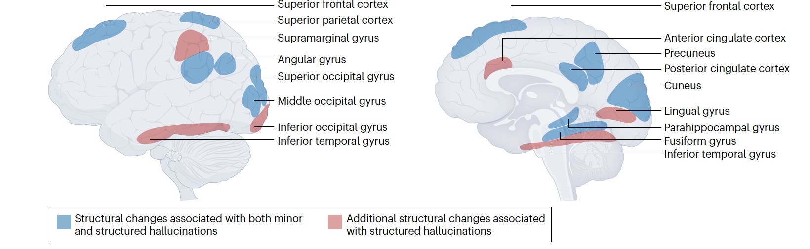 Grafik über die veränderten Hirnregionen bei Parkinson-Psychose