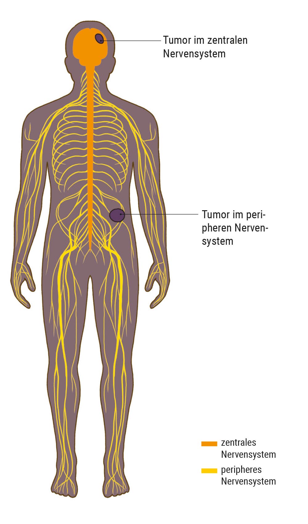 Darstellung des menschlichen Nervensystems mit Tumoren in zentralem und peripherem Nervensystem.