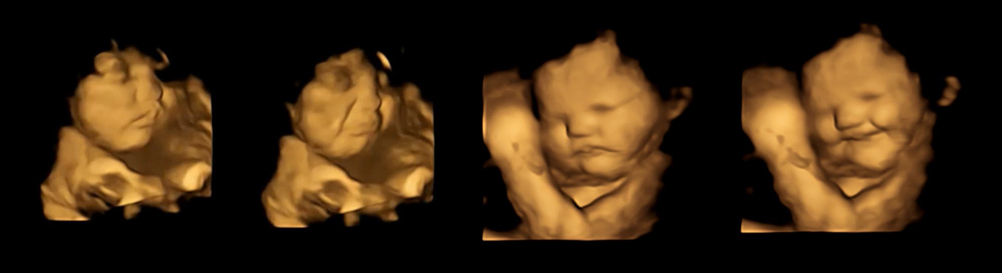 Dreidimensionales Ultraschallbilder von Föten mit unterschiedlichen Gesichtsausdrücken.