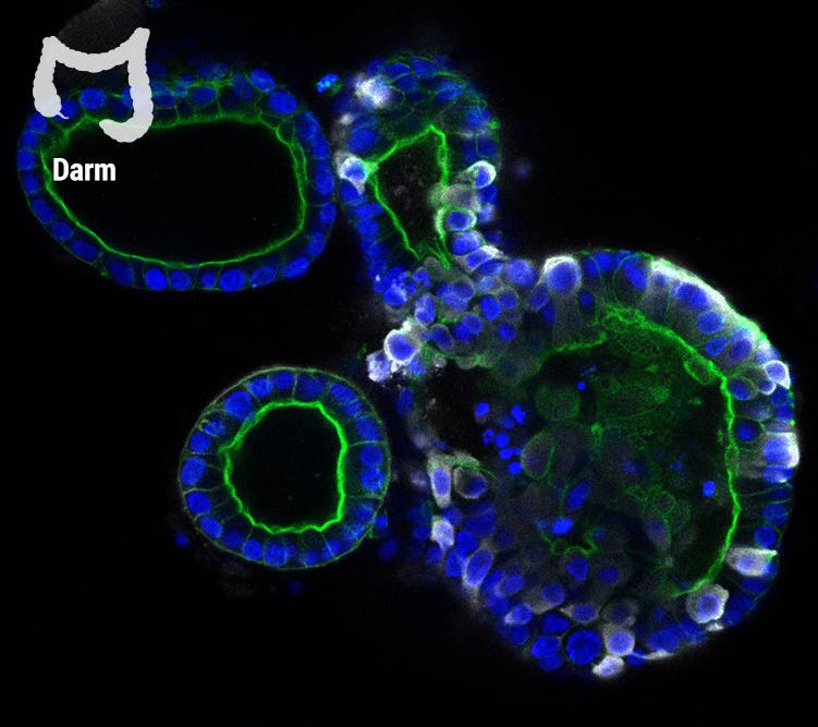 Auf dem Bild wird gezeigt, wie das Virus (weiß) das Darmorganoid infiziert. Das könnte erklären, warum manche Menschen Magen-Darm-Beschwerden bei einer Coronainfektion haben. 