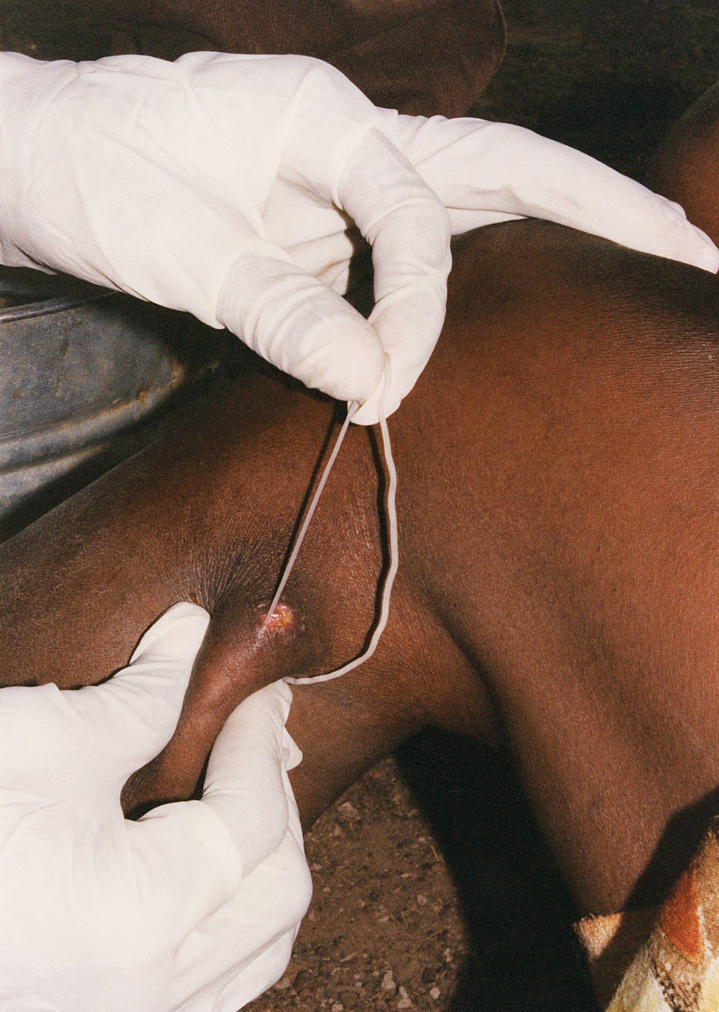 5  Dracontiasis: die Guineawurm-Krankheit
