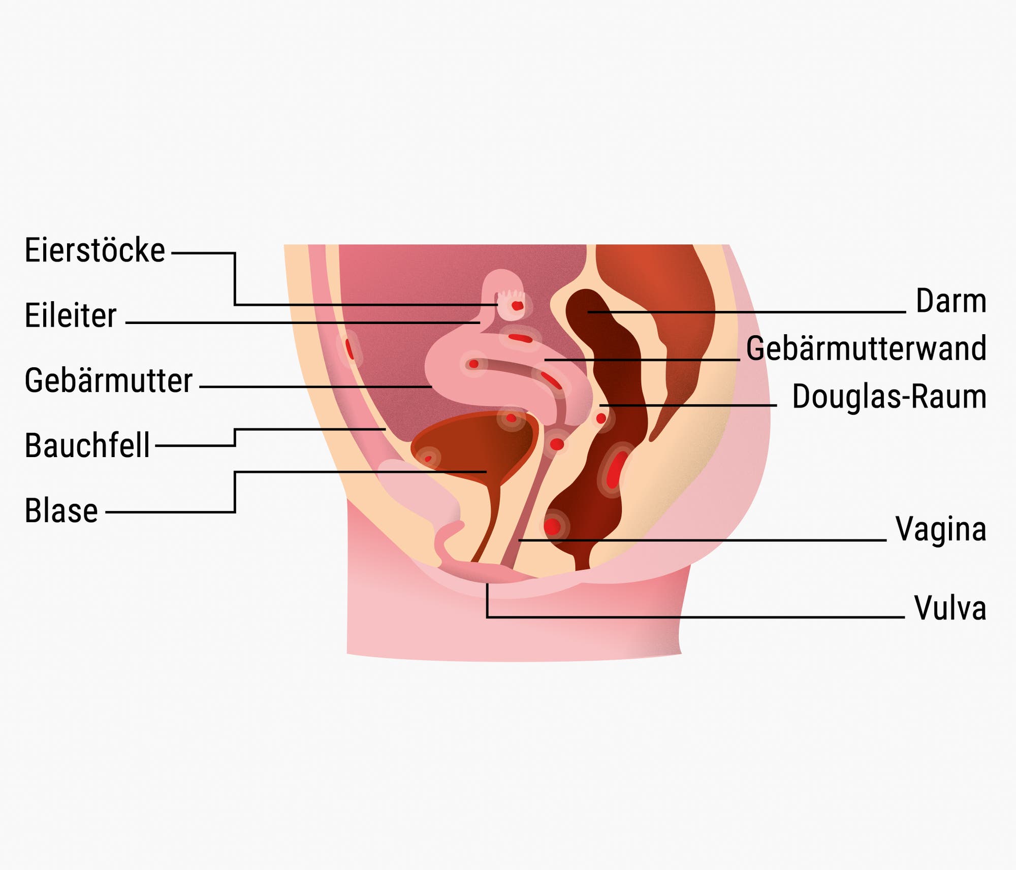 Endometrioseherde im Becken