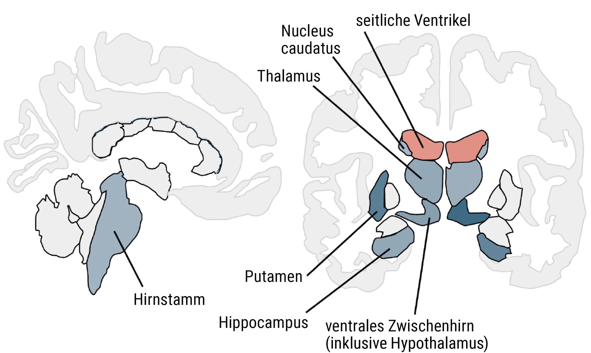 Volumenreduktionen in Kernregionen des mütterlichen Gehirns