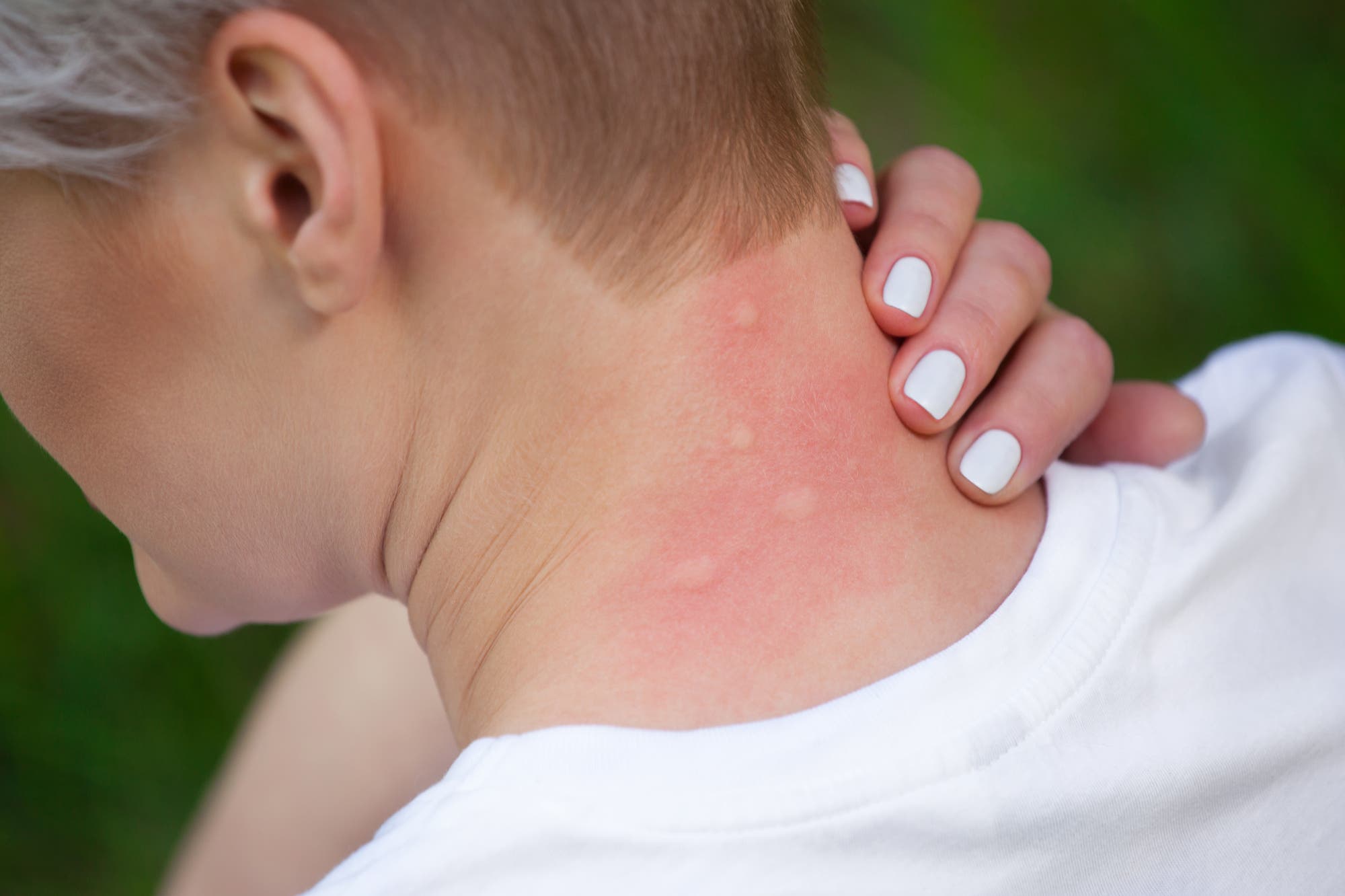Nacken einer Frau mit mehreren Mückenstichen.
