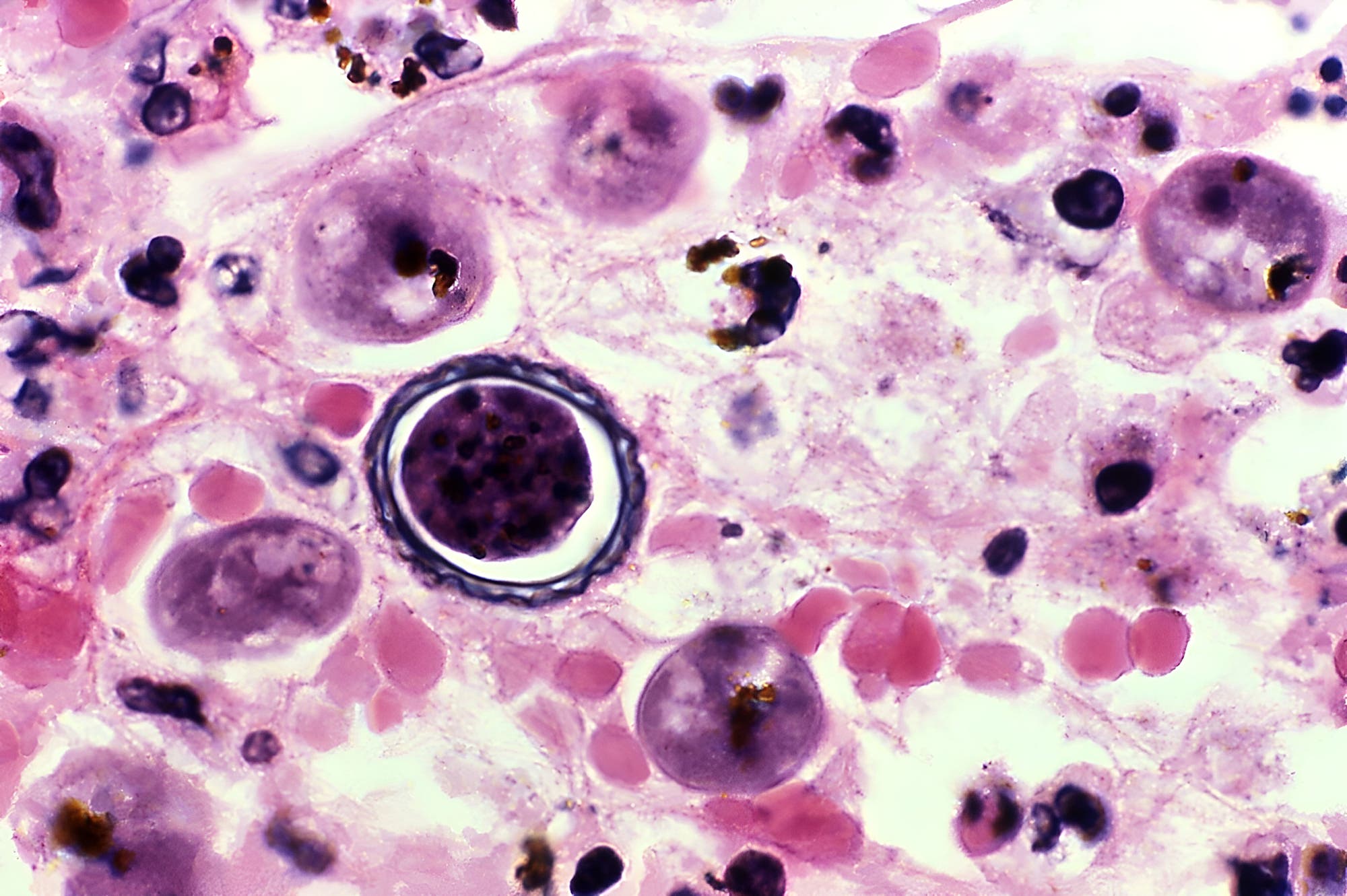 Mikroskopische Aufnahme von Gewebe, das mit einem rosa und violetten Farbstoff eingefärbt wurde. Im Bild sind mehrere runde Zellen sichtbar, darunter eine auffällige, größere Zelle mit einem dunklen, kreisförmigen Zentrum, das von einem klaren Rand umgeben ist. 