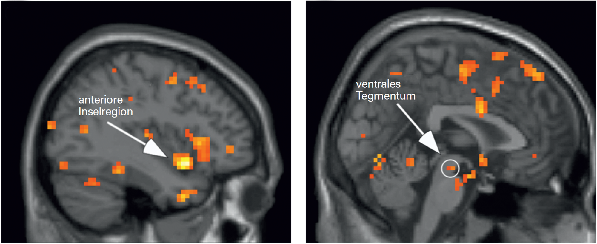 MRT-Aufnahmen vom Hirn hochsensibler und nichthochsensibler Menschen