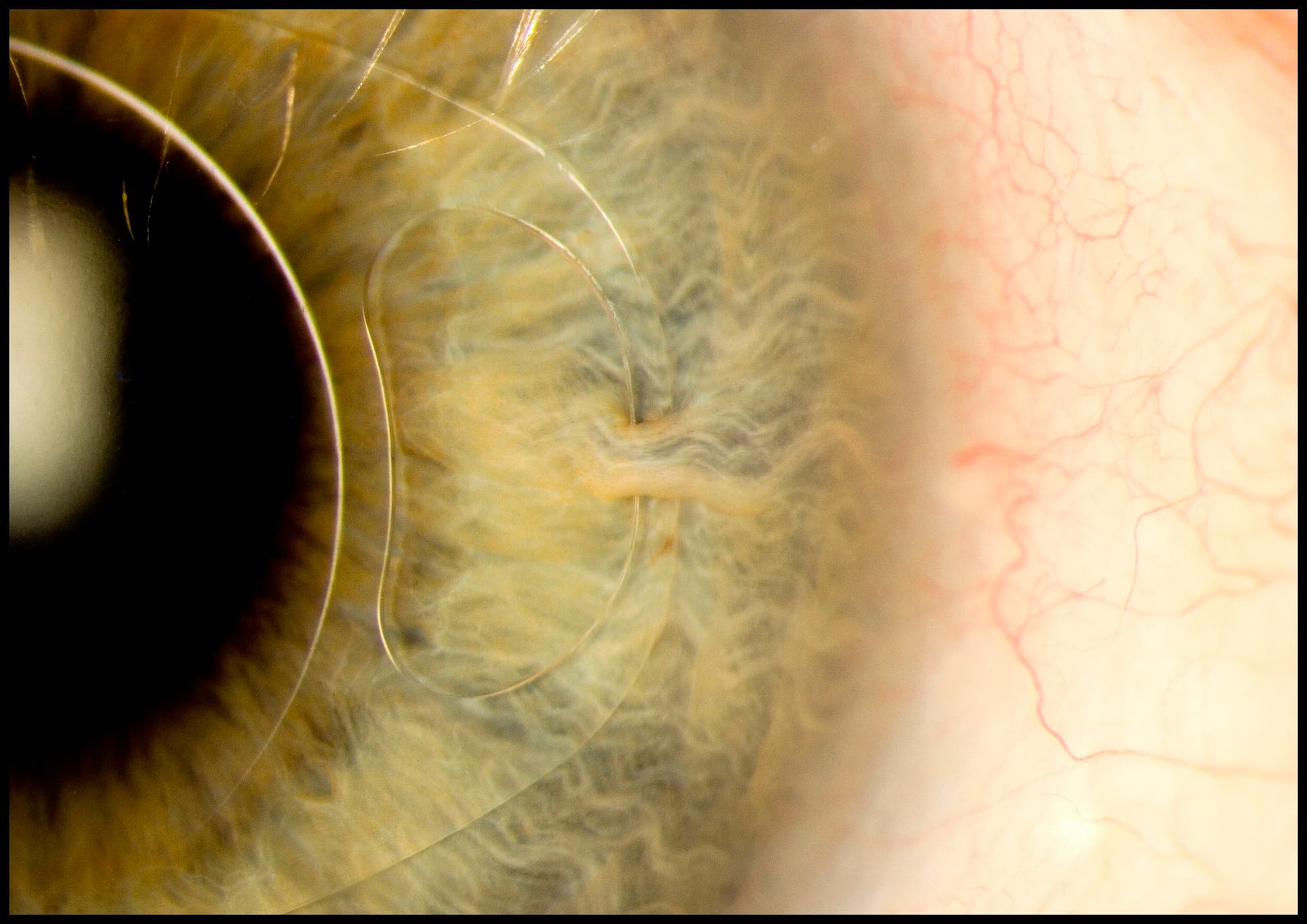 Iris-Clip-Linse im Auge