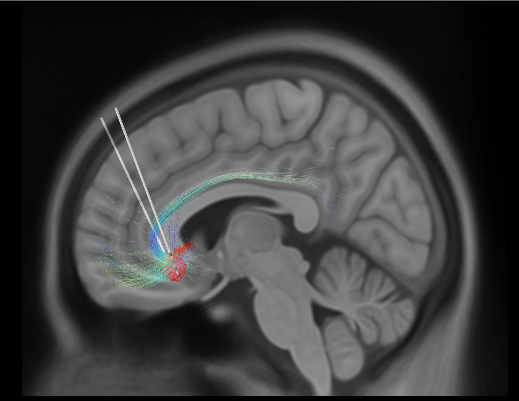 MRT-Bild eines Gehirns mit implantierten Elektroden 