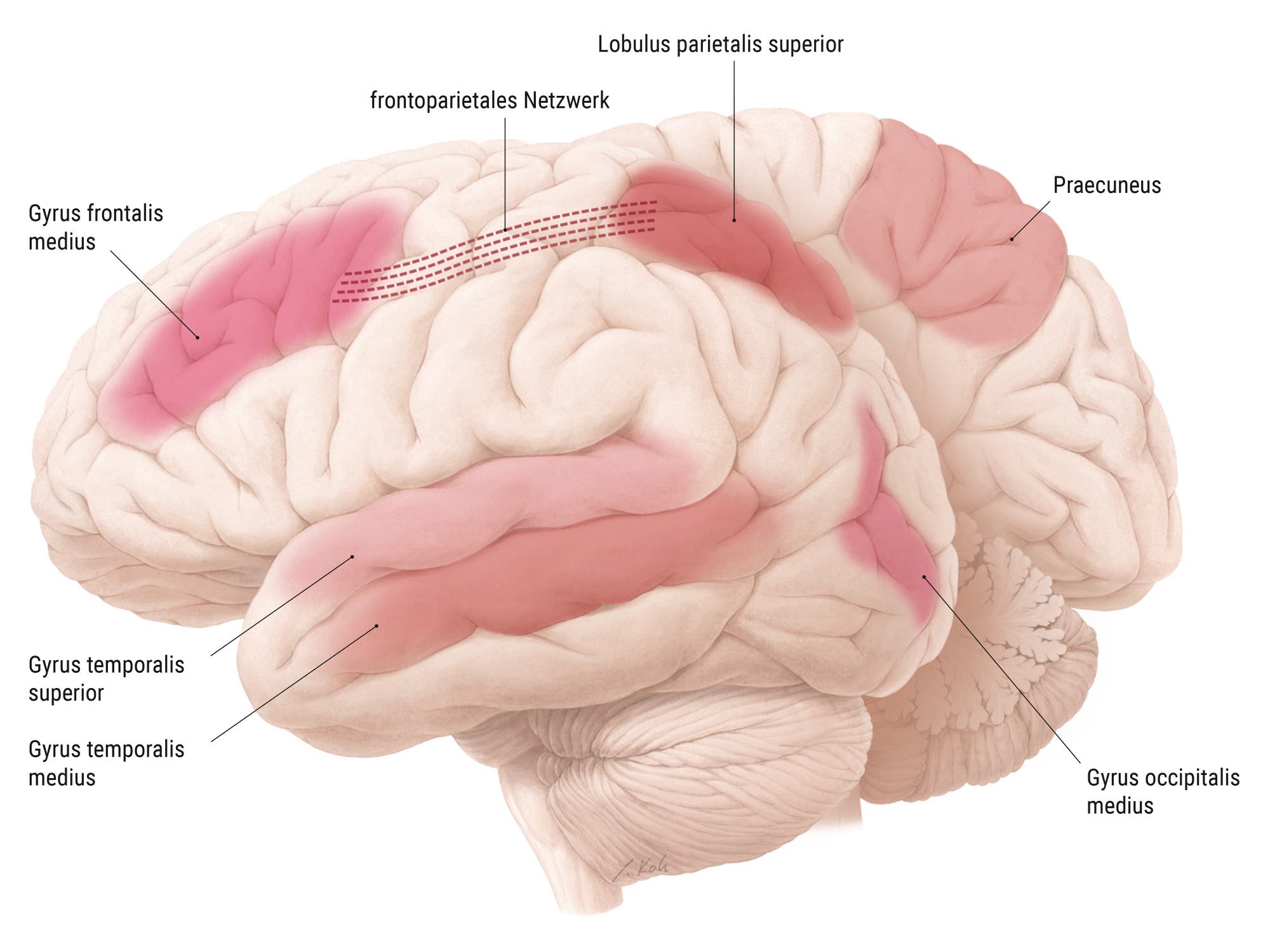 Grafik des menschlichen Gehirns, mit Markierung mehrerer Hirnregionen: Gyrus temporales superior und medius, Gyrus occipitalis medius, Praecuneus sowie frontoparietales Netzwerk