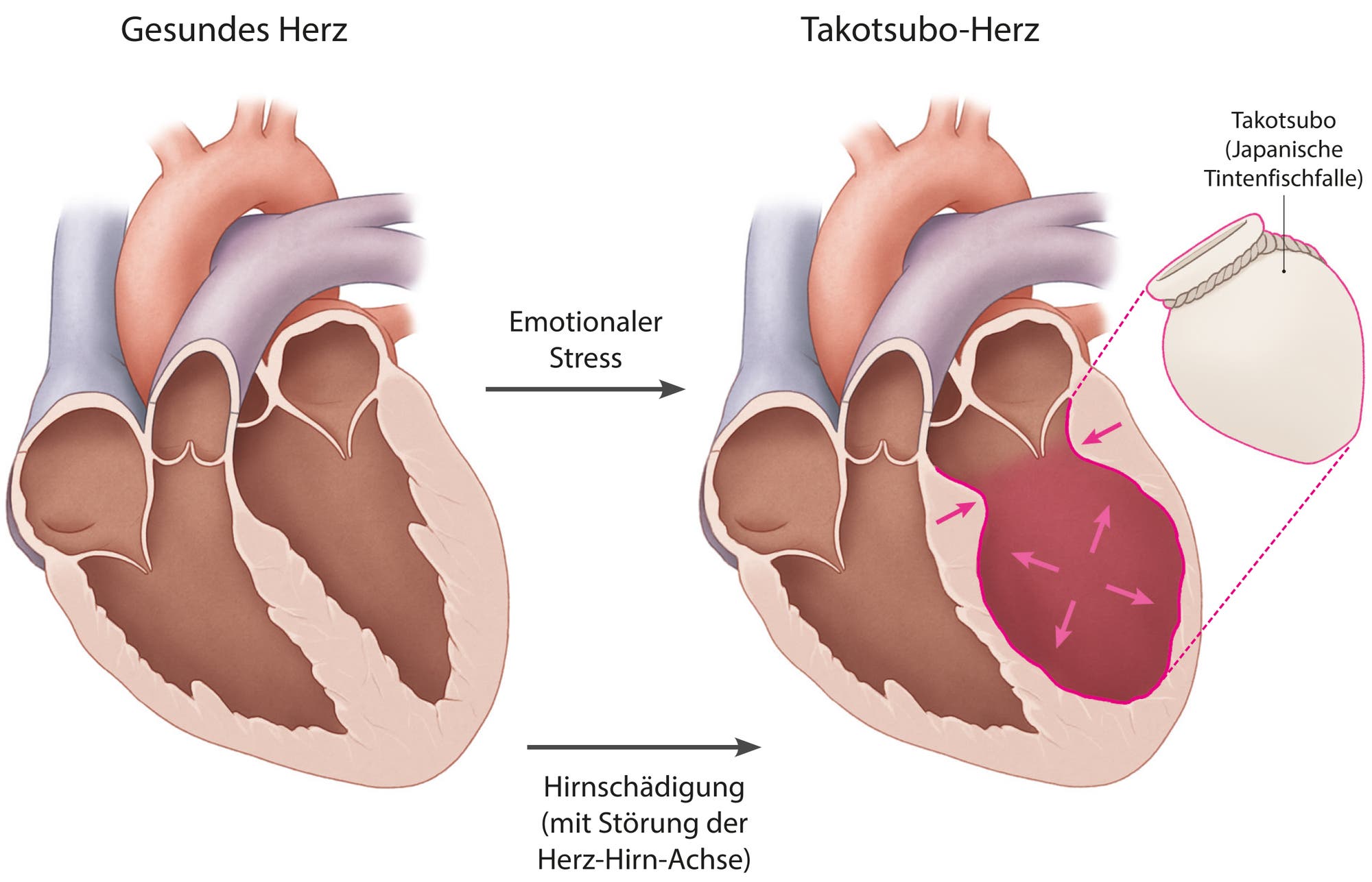 Infografik: gesundes und geblähtes Tsaketubo-Herz