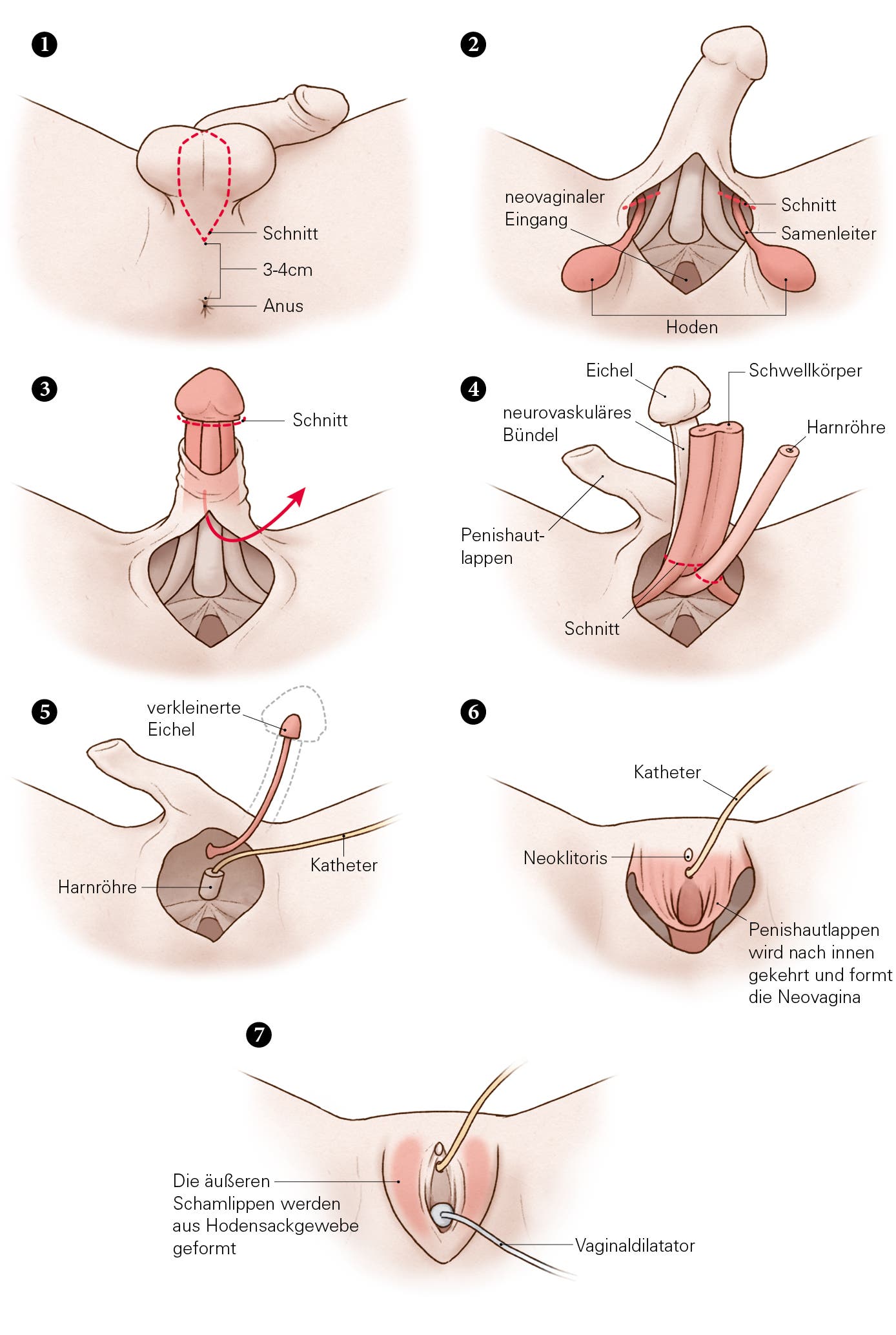 Mit Hilfe eines operativen Eingriffs, lässt sich aus einem Penis eine Neovagina formen. Mehrere Schritte sind dafür nötig.