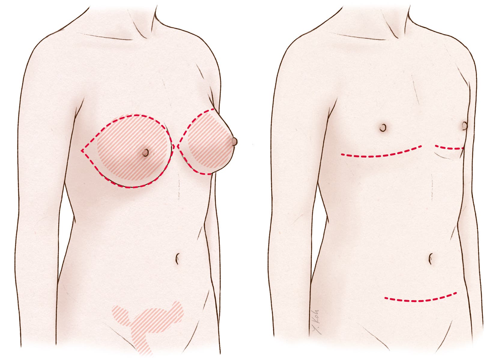 Unter Vollnarkose entfernen Chirurgen die Brüste. Außerdem formen und setzen sie die Brustwarzen um. 