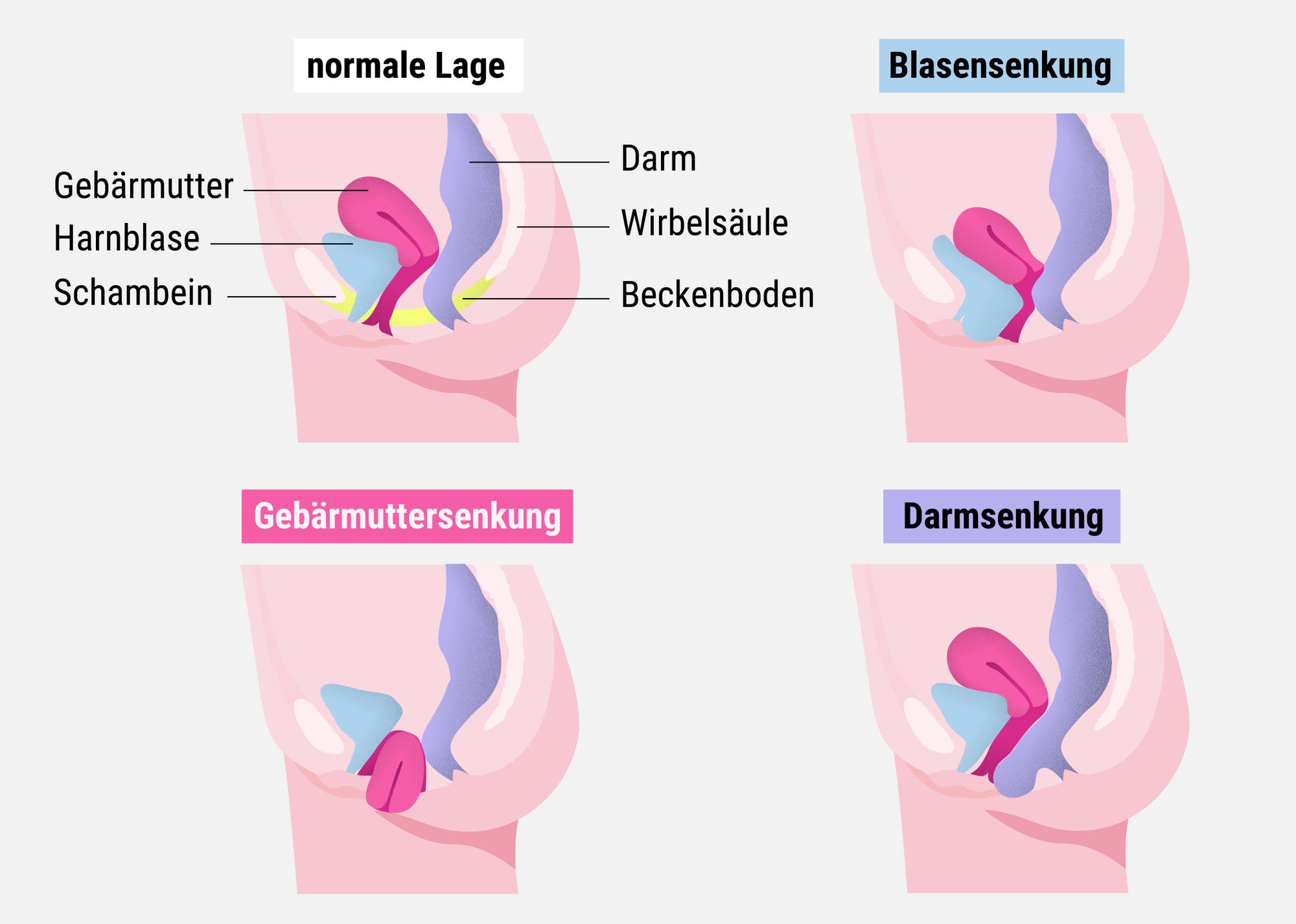 Anatomische Zeichnungen der Beckenorgane Harnblase, Gebärmutter, Darm und der Senkung der drei Organe