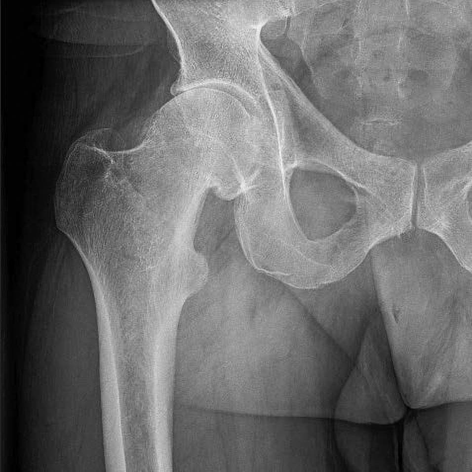 Röntgenbild eines menschlichen Beckens, das die Hüftgelenke und die Struktur der Beckenknochen zeigt. Die Knochen sind in Grautönen dargestellt, wobei die Konturen und Details der Knochenstruktur sichtbar sind. Das Bild dient der medizinischen Analyse und Diagnose von Knochenanomalien oder -verletzungen.