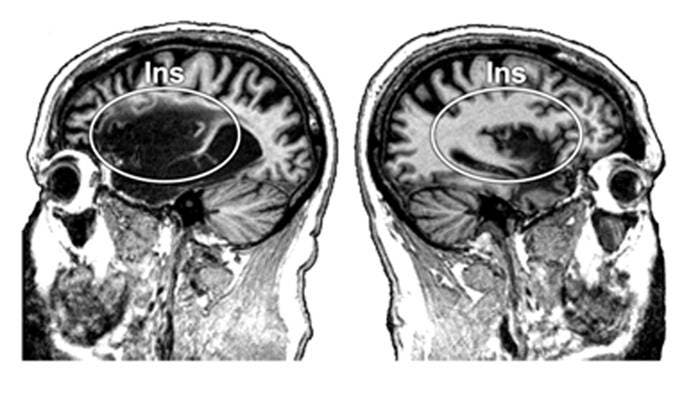 Gehirn mit zerstörter Insula