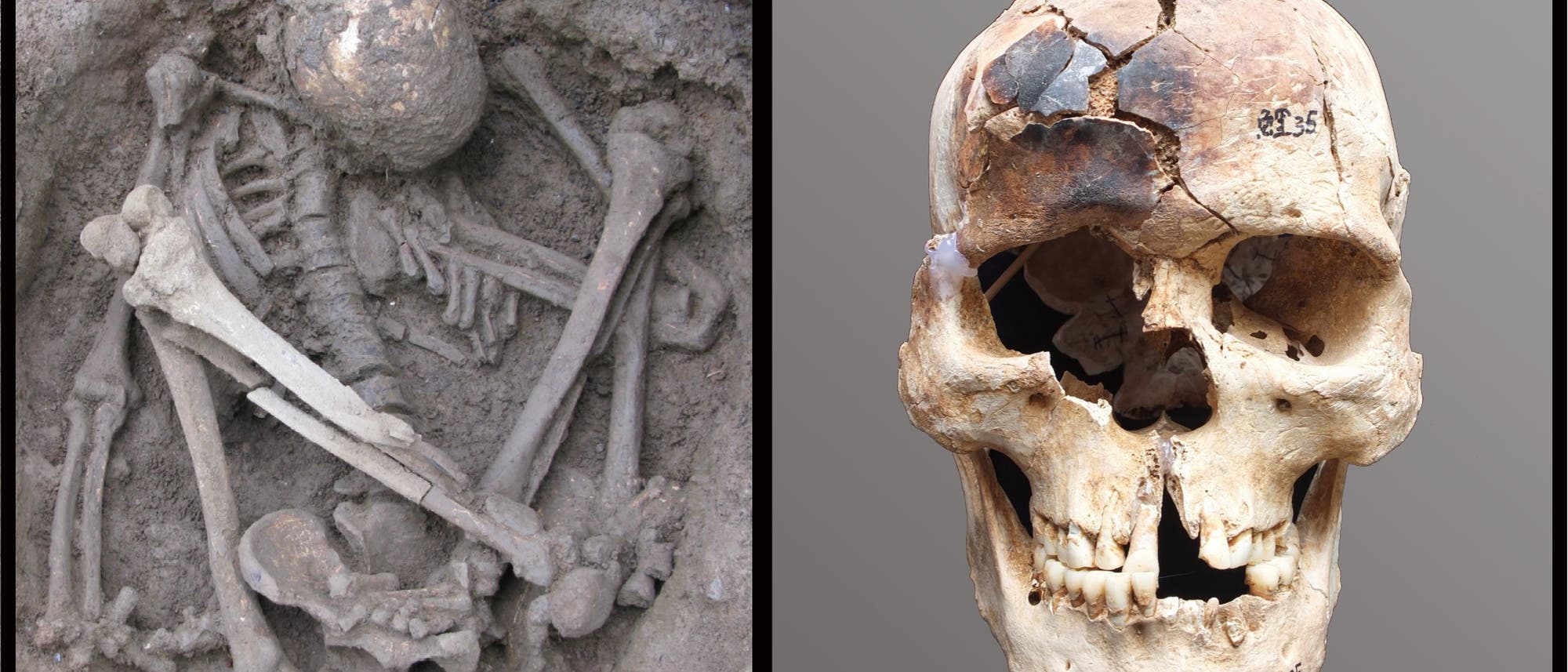 Das Bild zeigt zwei wissenschaftliche Abbildungen von menschlichen Skelettteilen. Links (A) ist ein vollständiges Skelett in einer gebückten Position im Erdreich zu sehen, möglicherweise eine archäologische Ausgrabung. Rechts (B) ist ein Schädel mit sichtbaren Rissen und Verfärbungen abgebildet. Beide Abbildungen bieten Einblicke in die menschliche Anatomie und archäologische Funde.